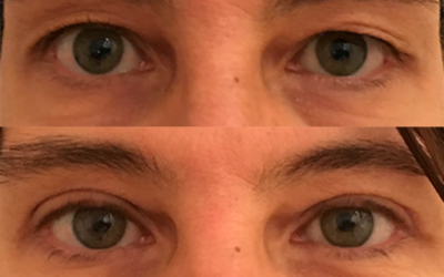 Refresca Tu Mirada: Cómo la Oculoplastia Combate el Exceso de Piel en los Párpados