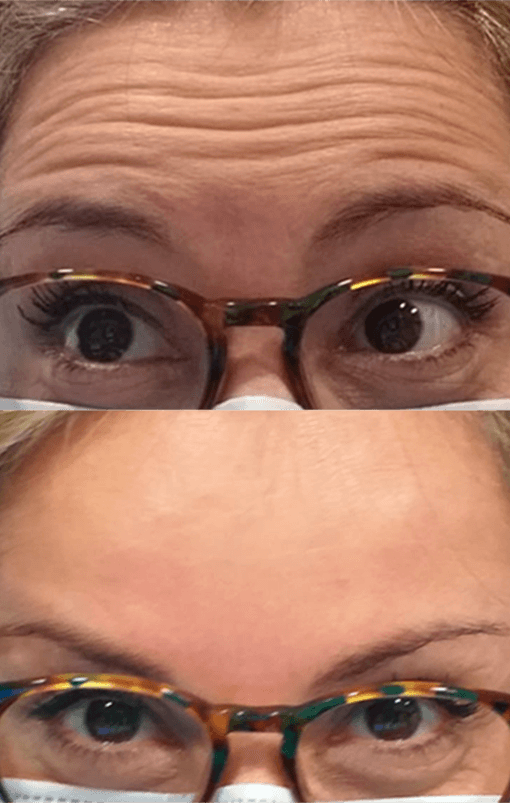 Botox oculoplastia