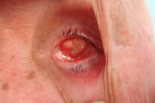 Cavidad anoftalmica oculoplastia