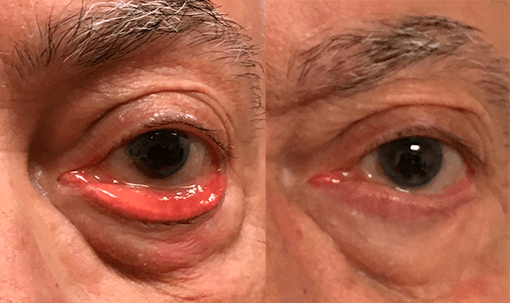 ectropion-oculoplastia