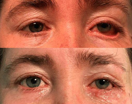 ectropion-oculoplastia