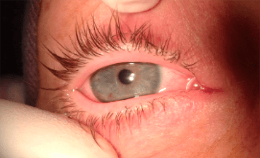 ojo-lloroso-adultos-dacriocistorrinostomia-oculoplastia
