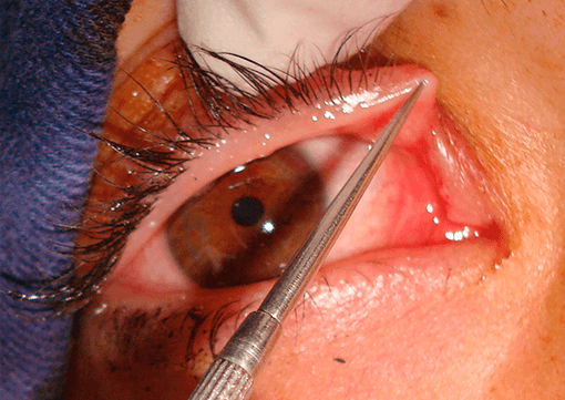 ojo-lloroso-adultos-reparacion-canaliculos-oculoplastia