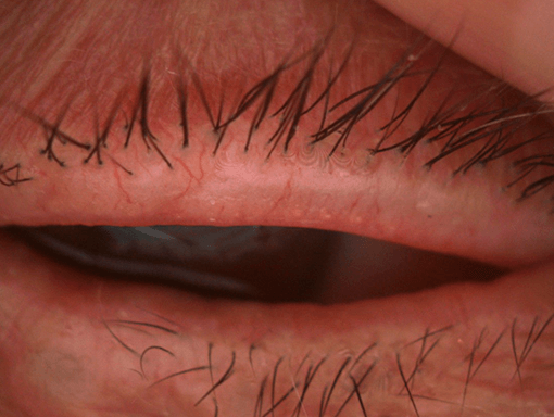 telangiectasias-borde-palpebral-oculoplastia