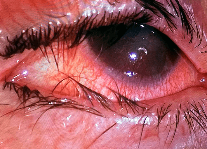 Malposición de pestañas Triquiasis | Oculoplastia - Dra. Varallo