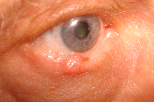 tumores-palpebrales-oculoplastia