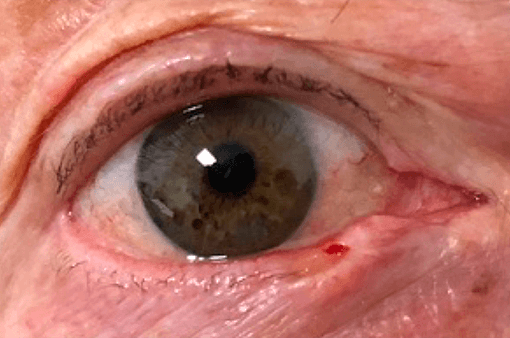 tumores-palpebrales-oculoplastia