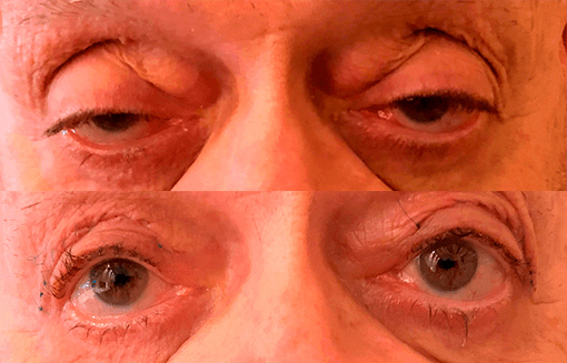Cirugía Ptosis Oculoplastia