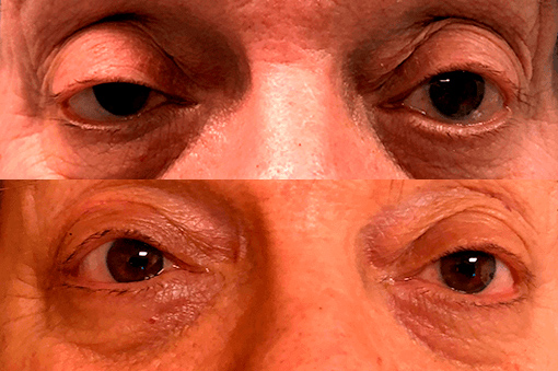 Cirugía de Ptosis Oculoplastia