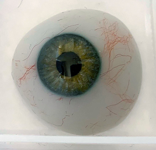 Prótesis Ocular