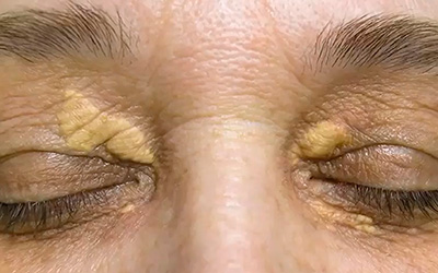 Manchas Amarillentas en Párpados (Xantelasmas): La Solución Estética y un Dato de Su Salud