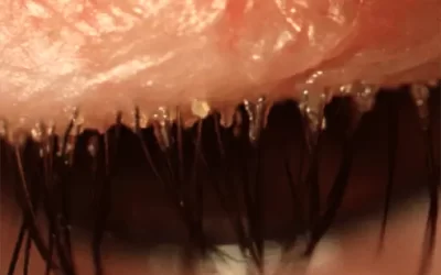 Blefaritis y drenaje de glándulas de Meibomio: un paso clave para el alivio
