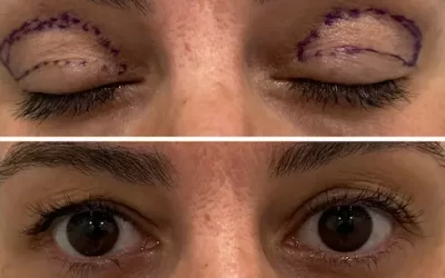 Dermatochalasis: ¿Tus párpados se ven caídos?