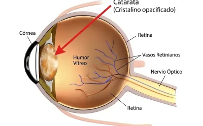Cataratas: ¿cuándo es el momento de operarse?